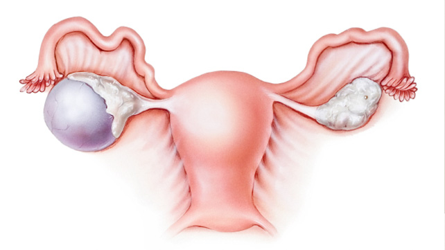 642x361_Cysts_and_Ovarian_Cancer