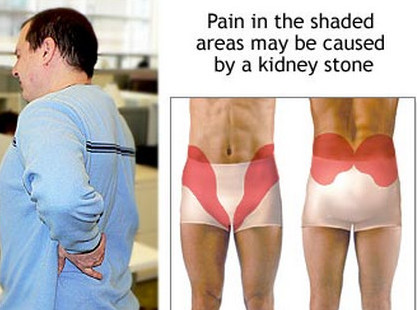 kidney-stones-pain-areas